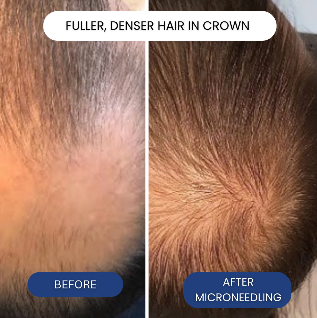 Micro-Infusion Peptide System For Hair Regrowth.